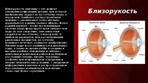 Миопия: какое воздействие оказывает на глазное яблоко?