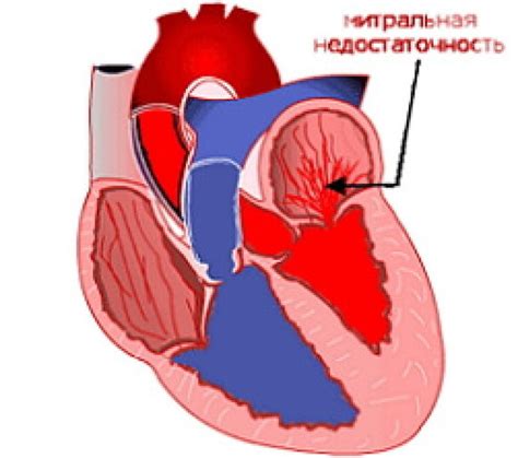 Митральная недостаточность: причины и последствия