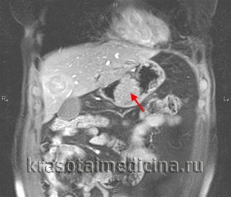 Молочно-железная опухоль: признаки и методы обнаружения