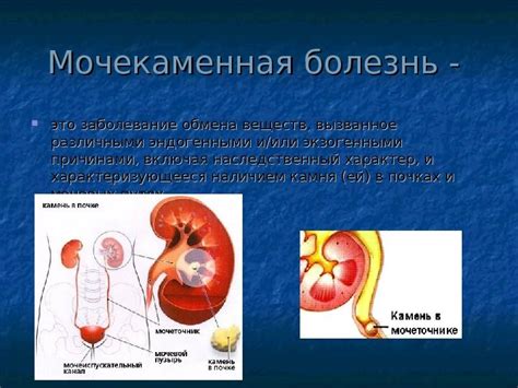 Мочекаменная болезнь у женщин: причины, симптомы и лечение