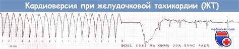 Наружная электрическая кардиоверсия дефибрилляция: