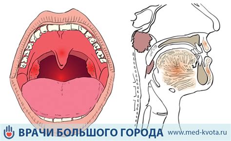 Нарушение голосовых связок в детском организме