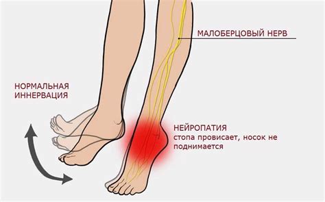 Нарушение кровоснабжения и нервов в стопе