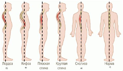 Нарушение осанки и повышенная физическая нагрузка