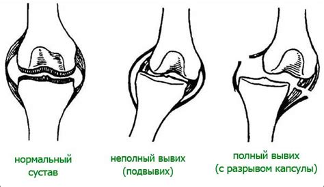 Немедленная первая помощь при вывихе колена