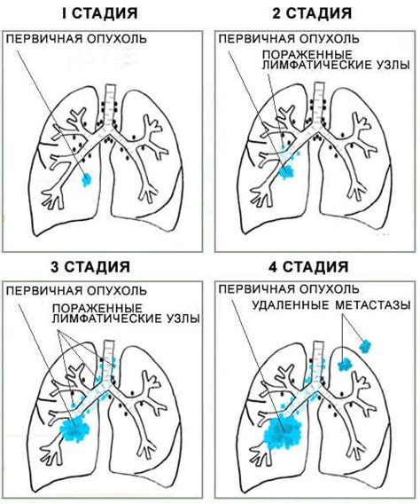 Неотложные действия при раке легких 4 стадии