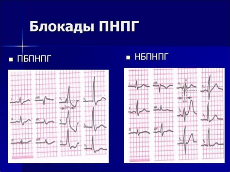 Неполная правая межжелудочковая блокада