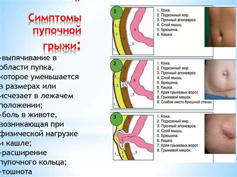 Несколько методов выявления грыжи пупка у ребенка 8 лет