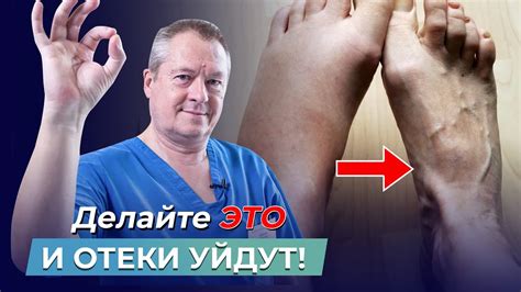 Облегчение отеков методом лимфодренажа