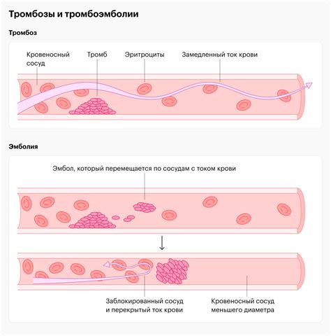 Образование тромбов и тромбоэмболий