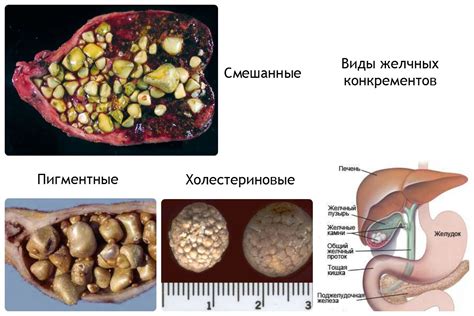 Опасности камня в желчном пузыре