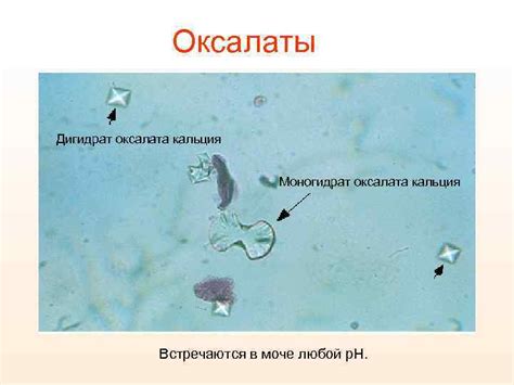 Опасность повышенного кальция в моче