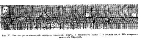 Опасность экстрасистолии и ее возможные последствия