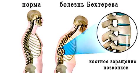 Описание синдрома Бехтерева