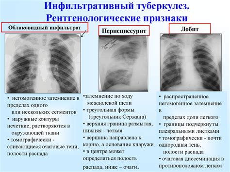 Определение ОГК при пневмонии