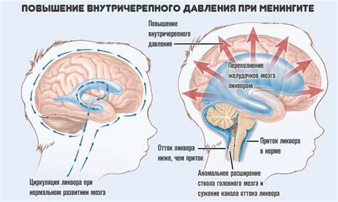 Определение внутричерепного давления