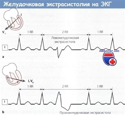 Определение желудочковой экстрасистолии бигеминия на ЭКГ