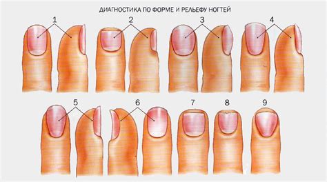 Определение заболеваний по цвету ногтей