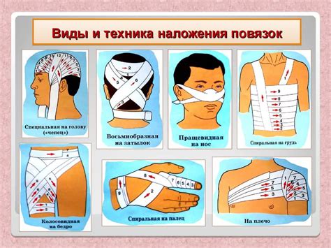 Определение крестообразной повязки