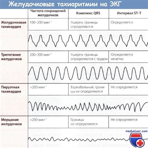 Определение трепетания и фибрилляции желудочков