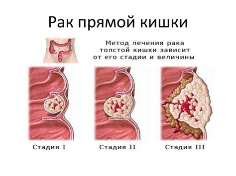 Опухоль в прямой кишке: симптомы и диагностика