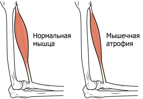 Ослабление мышц и их атрофия