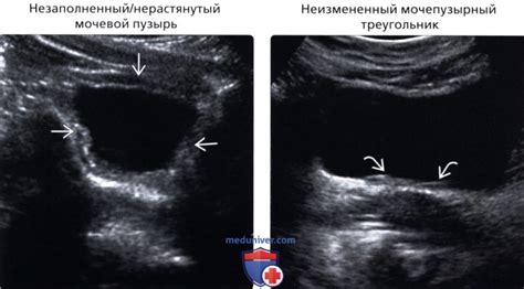 Осложнения, связанные с утолщением стенок мочевого пузыря