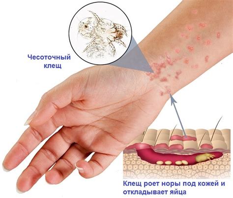 Осложнения при чесотке на левой ляжке у девушки