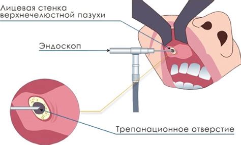 Основные методы удаления кисты в пазухе