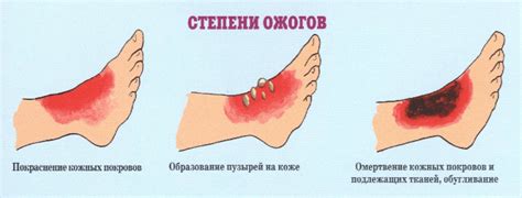 Основные признаки открытой раны от ожога