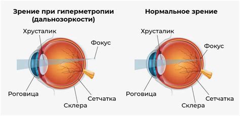 Основные причины и симптомы гиперметропии