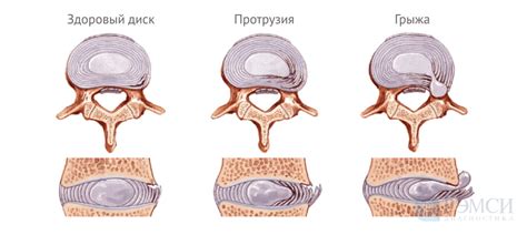 Основные причины и факторы развития грыж дисков