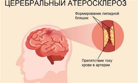 Основные причины расширения сосудов головного мозга