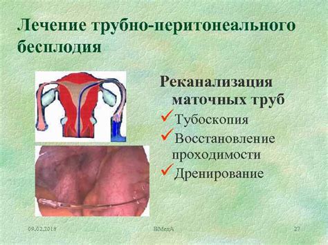 Основные причины трубно перитонеального бесплодия