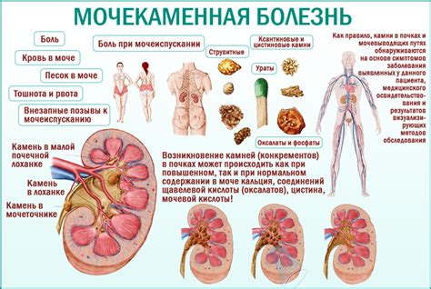 Основные симптомы мочекаменной болезни у женщин