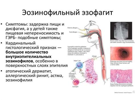 Основные симптомы эозинофильного эзофагита