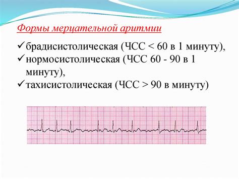 Особенности и проявления нерегулярного ритма