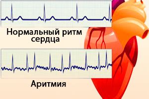 Особенности наджелудочковой экстрасистолии