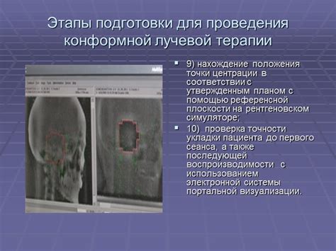 Особенности 3D конформной лучевой терапии