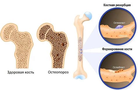 Остеопороз и его связь с трабекулярной перестройкой костей