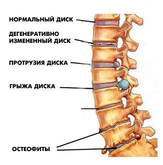 Остеохондроз и грыжа межпозвонковых дисков