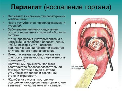 Острый ларингит