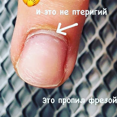 Отделение кутикулы