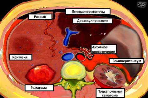 Отек и кровоизлияние после травмы