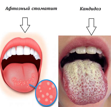 Ощущение жжения во рту: возможные причины