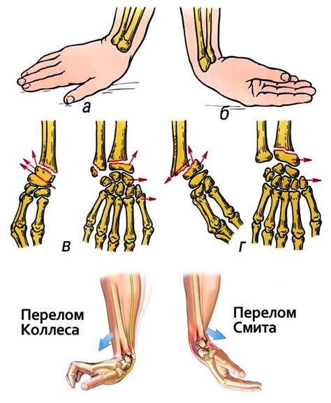 Первая помощь при лопнувшей вене на кисти руки