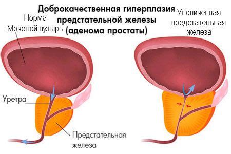 Перспективы применения афалазы в лечении аденомы простаты