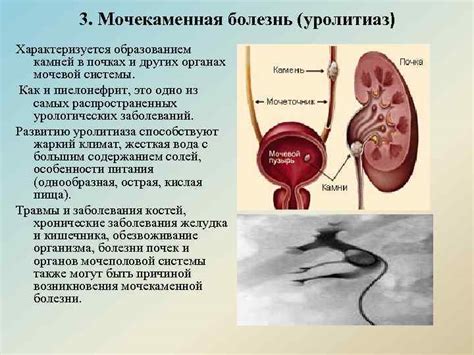 Питание при камне в мочеточнике