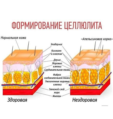 Победить целлюлит