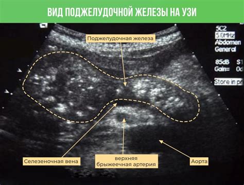 Повышена эхогенность перивентрикулярной области